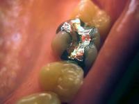 A mercury amalgam filling.